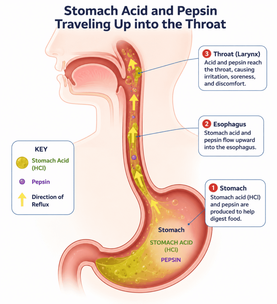Diagram illustrating how pepsin reflux reaches the throat in laryngopharyngeal reflux