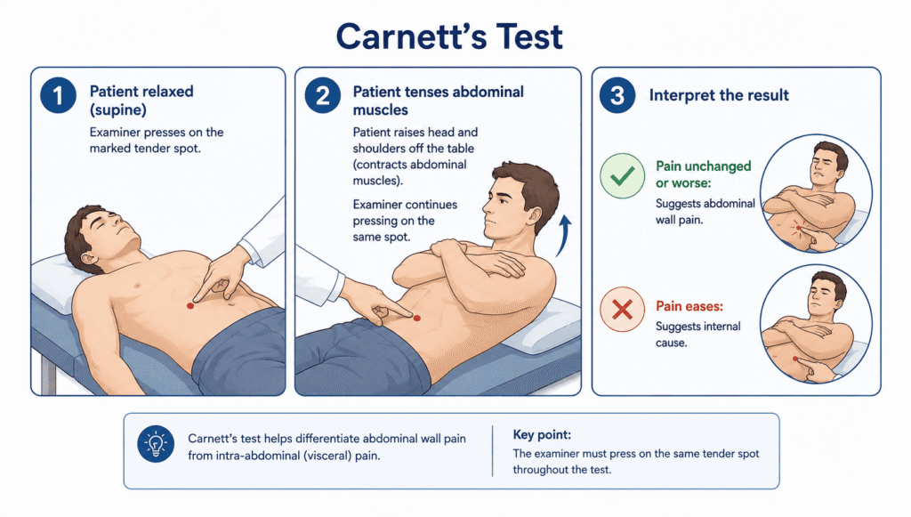 Step-by-step illustration of the Carnett's test used to diagnose chronic abdominal wall pain