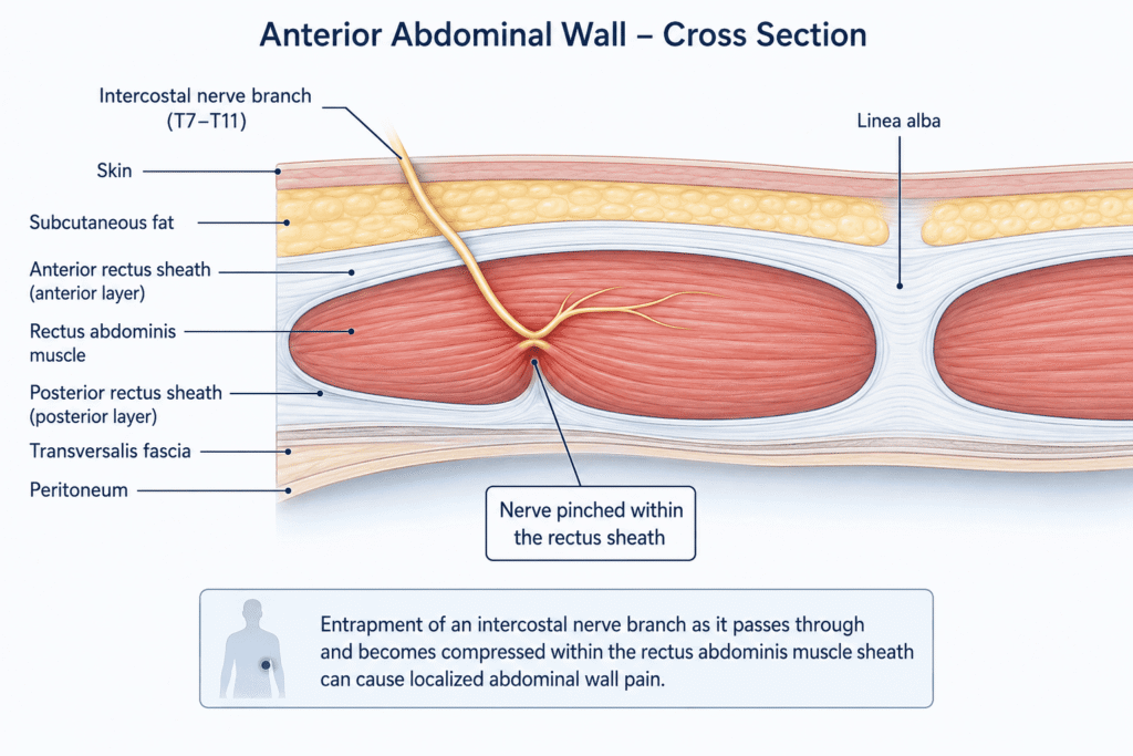 Illustration showing nerve entrapment causing chronic abdominal wall pain in the rectus muscle