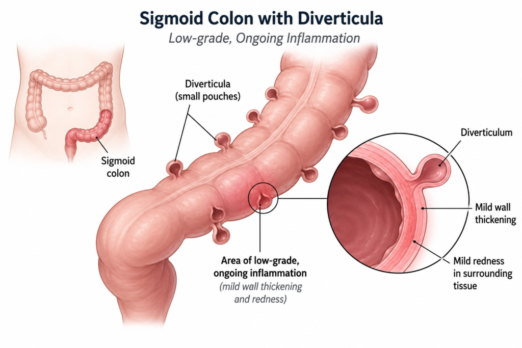 Illustration of sigmoid colon diverticula with an area of chronic low-grade inflammation, representing smoldering diverticulitis