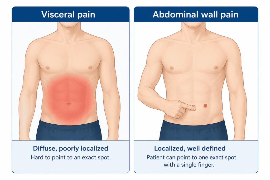 Comparison of diffuse visceral pain versus the pinpoint tenderness of chronic abdominal wall pain